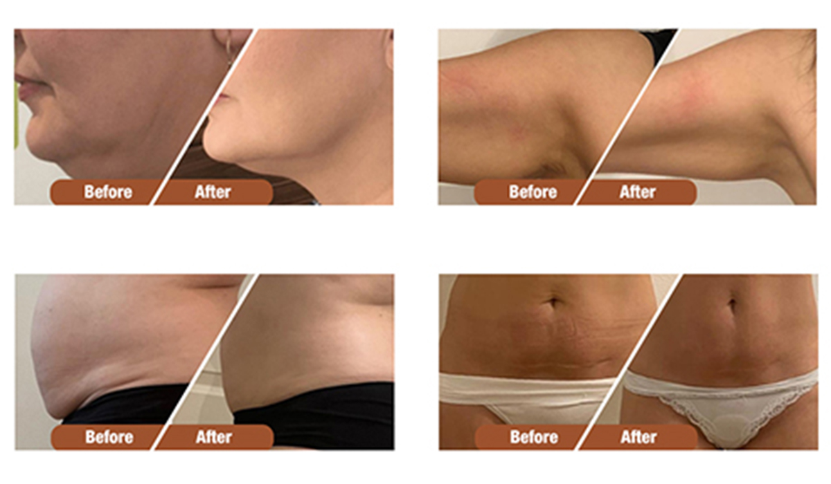 ultrasound cavitation before and after