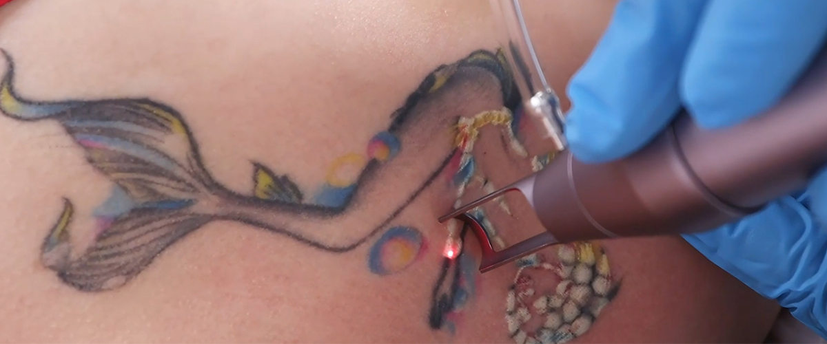 tattoo removal laser