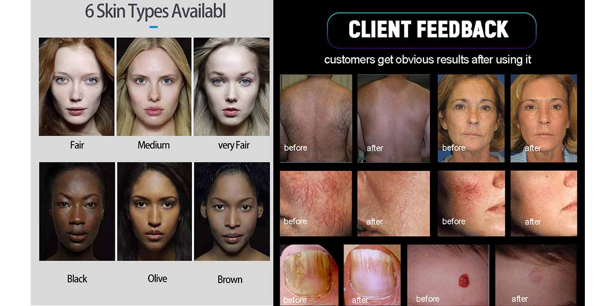 laser hair removal alexandrite