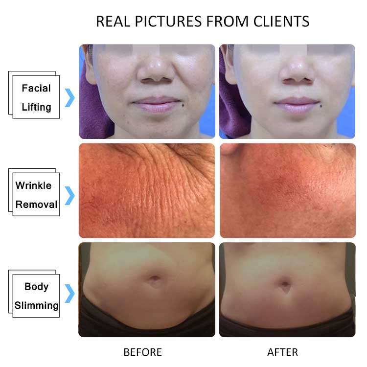 Professional 4D Hifu Machine Portable