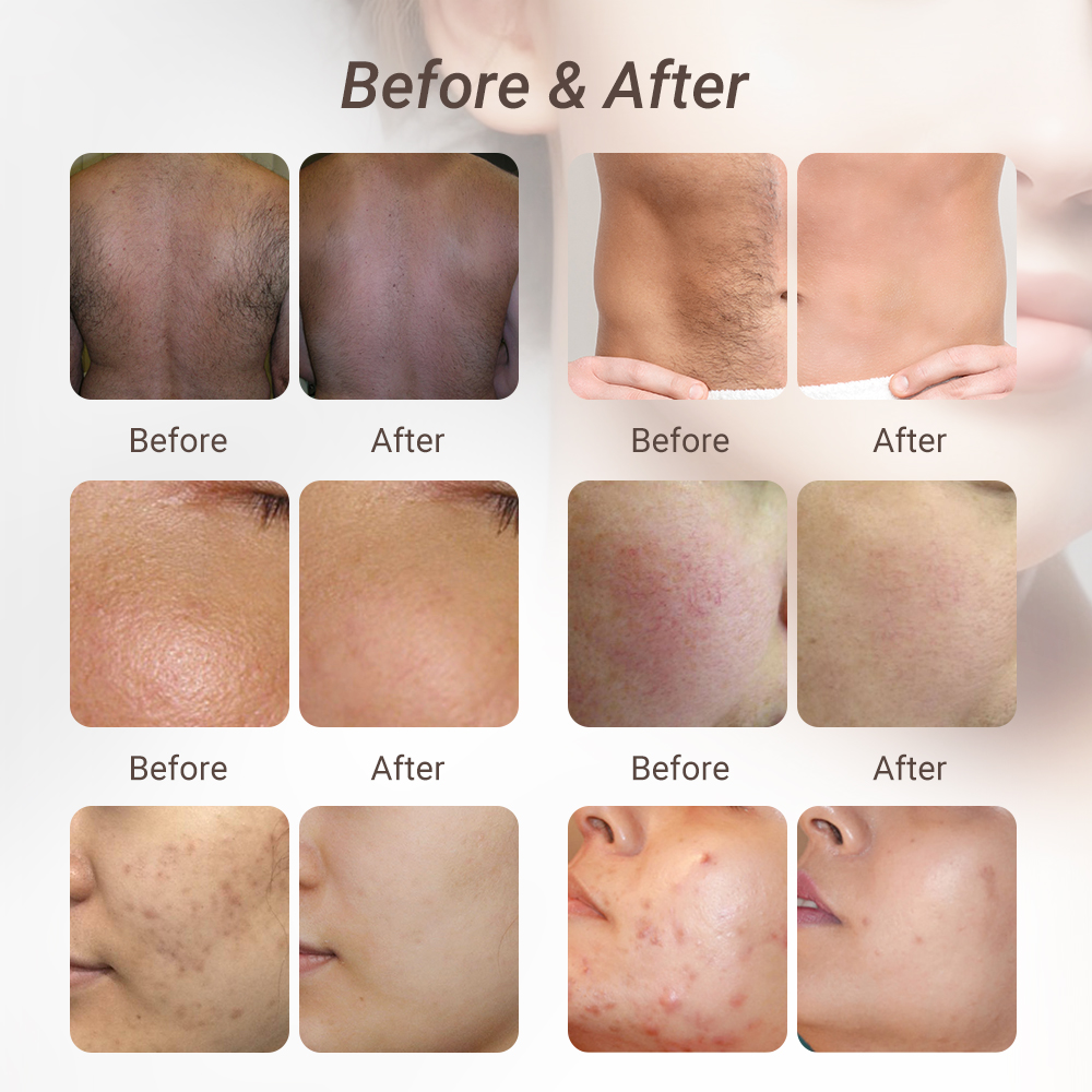 NIR DPL Laser Skin Care Machine Portable